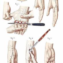 Disarticulation of the four fingers and of the metacarpal bones