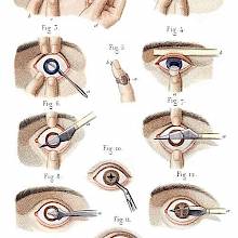 Cataract and Artificial Pupil