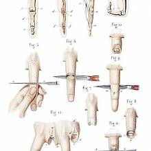Disarticulation of phalanges and finger