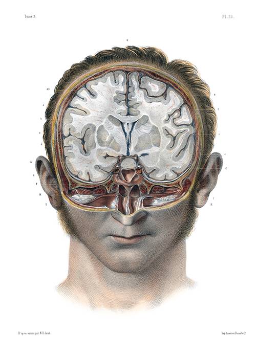 Head of a man cut away along the frontal & transverse planes, exposing a cross-section of the brain