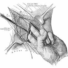 Surgical operation showing the surgeon insertiong two fingers inside a muscle incision