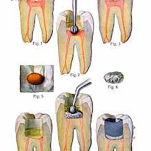 Plate showing the various steps involved in pulpotomy and cavity filling