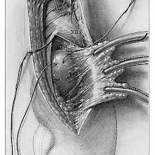 Surgical operation involving the suturing of the kidney with two different needles