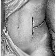 Plate showing a woman's torso bearing a T-shaped surgical incision on the side of abdomen