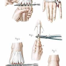 Amputations in the continuity of the bones