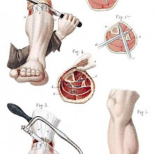 Amputation of the Leg