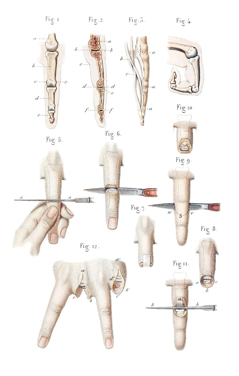 Disarticulation of Phalanges and Finger – Old Book Illustrations