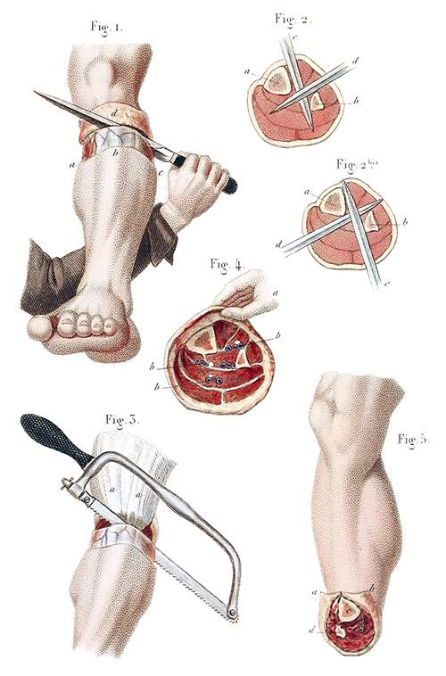 Amputation of the Leg