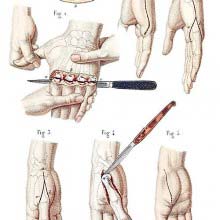 Disarticulation of the four fingers and of the metacarpal bones