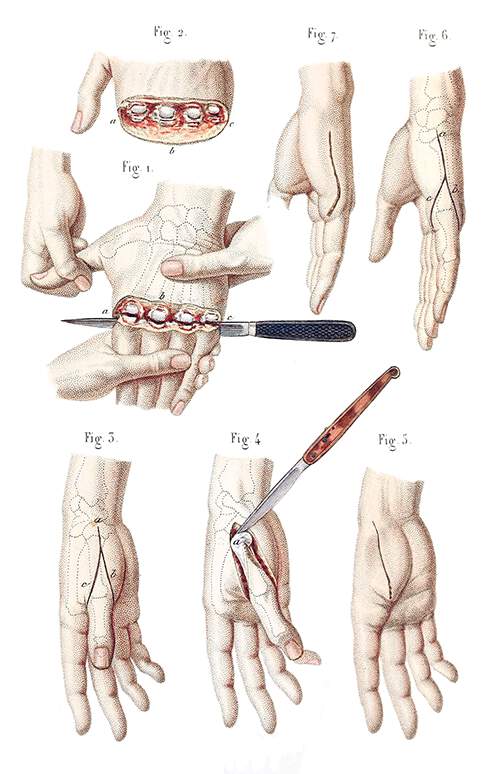 Disarticulation of the four fingers and of the metacarpal bones