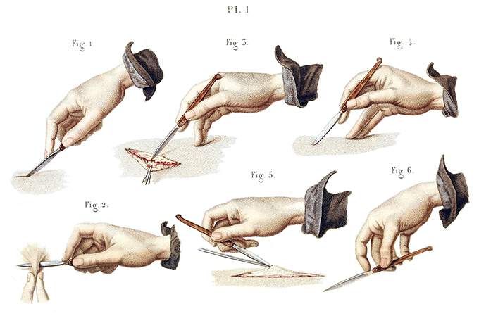 Methods of holding the bistoury