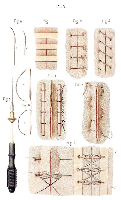 Sutures