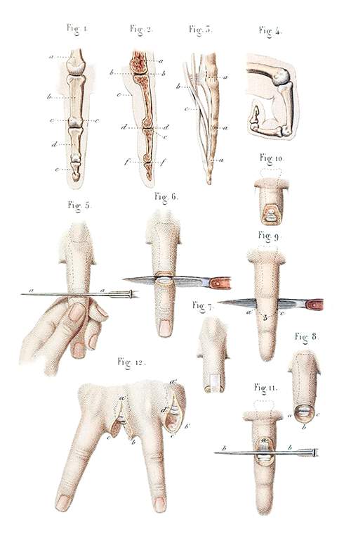 Disarticulation of phalanges and finger