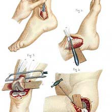 Resections Performed on the lower extremity