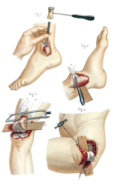 Resections Performed on the lower extremity