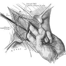 Surgical operation showing the surgeon insertiong two fingers inside a muscle incision