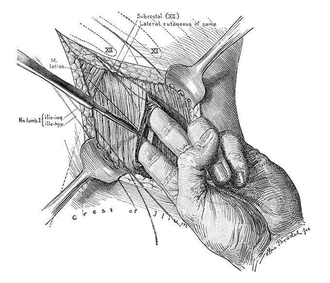Surgical operation showing the surgeon insertiong two fingers inside a muscle incision