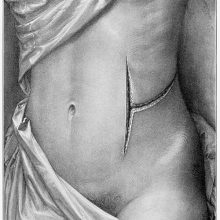 Plate showing a woman's torso bearing a T-shaped surgical incision on the side of abdomen