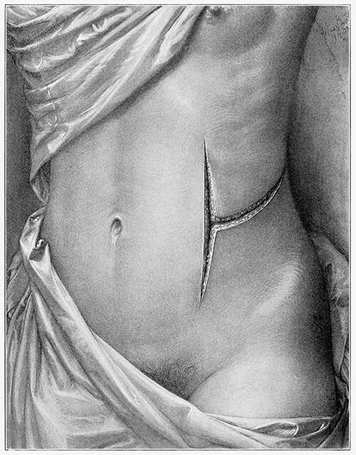 Plate showing a woman's torso bearing a T-shaped surgical incision on the side of abdomen