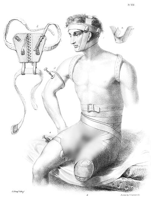 Medical plate showing a sitting man who had his leg amputated wearing various bandages