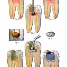 Plate showing the various steps involved in pulpotomy and cavity filling