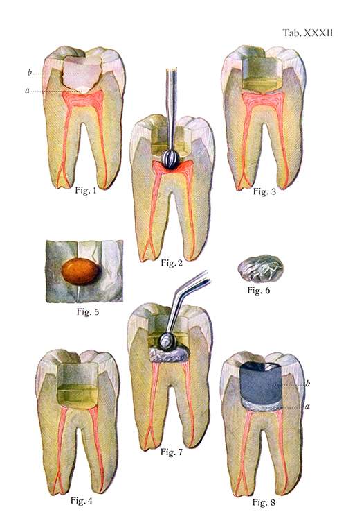 Plate showing the various steps involved in pulpotomy and cavity filling